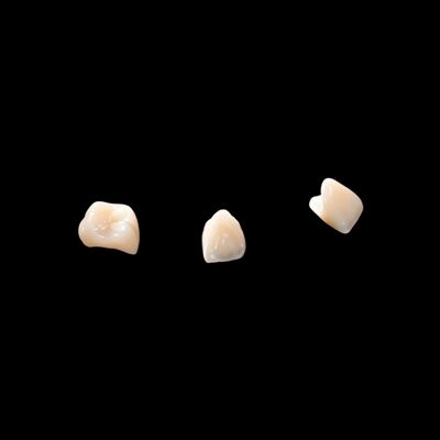 Porselen CAD/CAM Digabungkan dengan Jembatan Zirconia Untuk Memulihkan Penampilan Alami