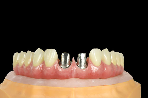 Beli FDA Titanium Bridge Implan Gigi Titanium Frame Dengan Mahkota online manufacture