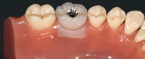 Beli Crown Implant Crown Bridge Logam logam mulia yang sangat estetis online manufacture