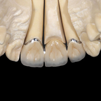 Beli Non-Premia PFM Crown Implant Porselen Dipecat ke Metal Crown online manufacture