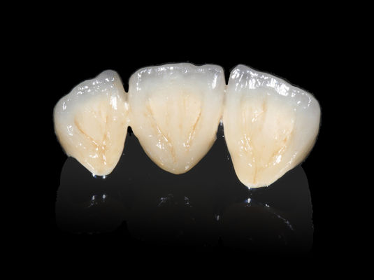Beli Implant Dental PFM Bridge Non Precious CAD CAM PFM Crown online manufacture