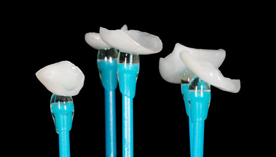 EMAX Ditekan Onlay Veneer Keakuratan Tinggi Dental Veneer Cocok