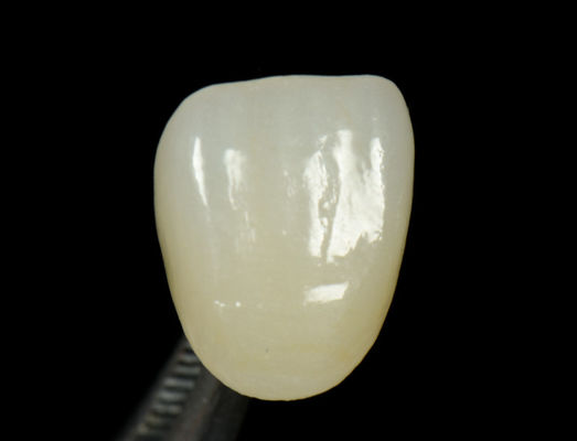 Customisable Emax Press Crown Cepat Dan Tinggi Estetika Dental Inlay Onlay