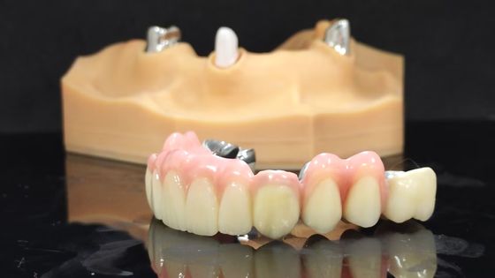 Titanium Crown dan Jembatan Kekuatan Tinggi Mengatasi Komposit