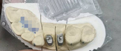 Metal / Ti Base Crown Post Core Titanium Crown Untuk Gigi