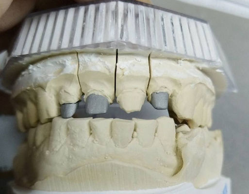 Post Core Non Precious Metal Crown And Bridge Kekuatan yang kuat Disesuaikan