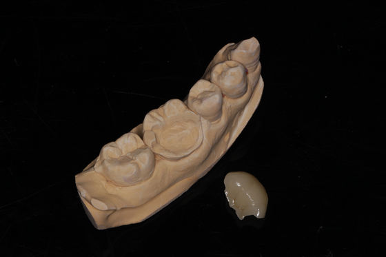 Dental Composite Onlay Veneer Estetika Tinggi Composite Veneer